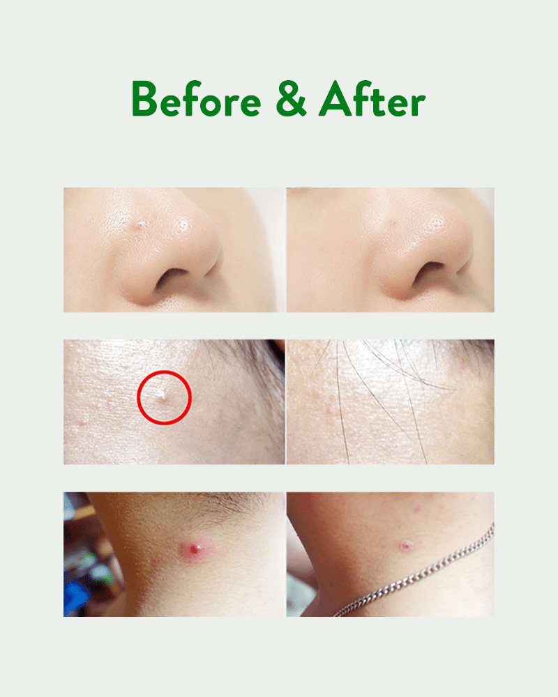 Acropass Trouble Cure 6 Patches